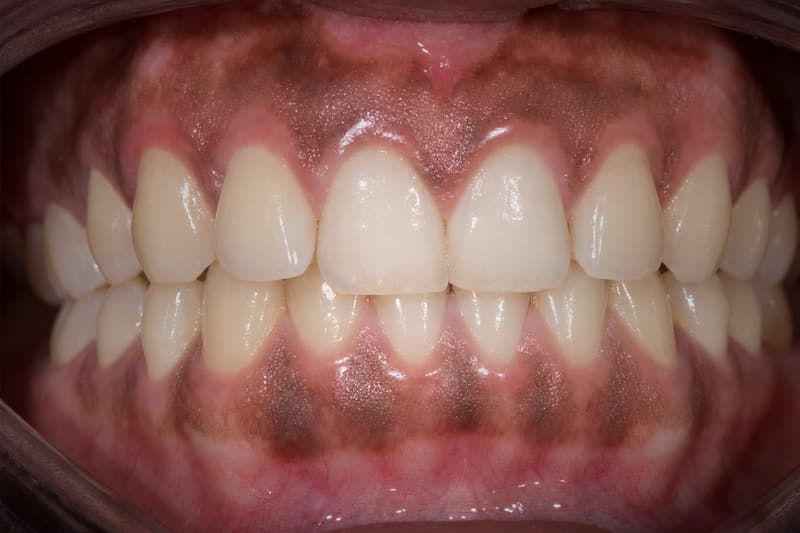 Gengiva saudável com manchas acastanhadas de pigmentação melânica natural