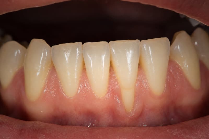 Retração gengival em incisivo inferior, com raiz exposta e gengiva fina ao redor