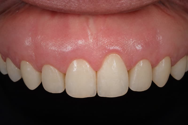 Contorno gengival irregular nos dentes superiores da frente, que parecem curtos e de alturas diferentes