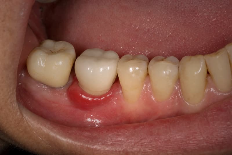Gengiva avermelhada e inchada ao redor de uma coroa sobre implante, nos dentes de trás inferiores