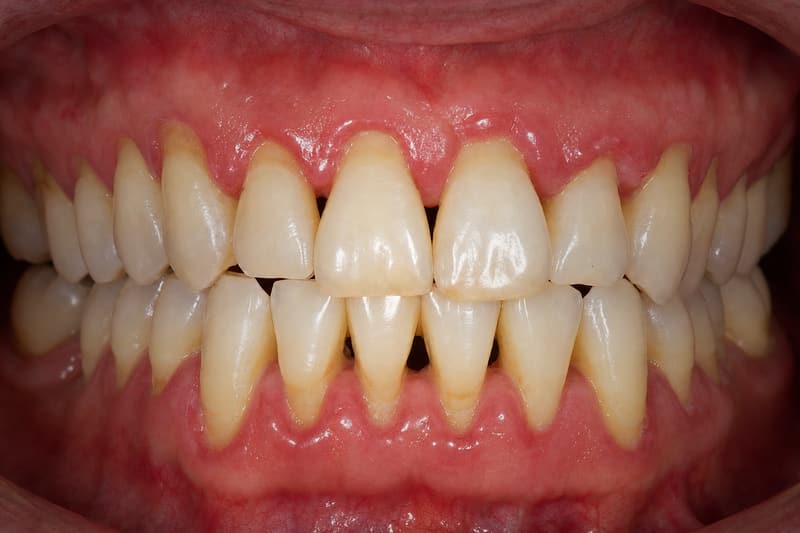 Gengiva inflamada, com perda do contorno e leve retração nos dentes da frente, quadro de periodontite