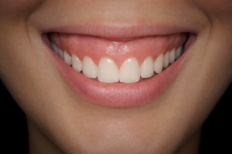 Sorriso que mostra uma faixa larga de gengiva acima dos dentes superiores, o sorriso gengival